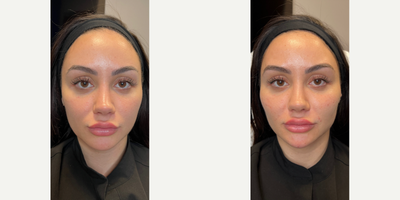 25-34 year old woman treated with Bellafill - BEAUTIFUL BALANCE WITH BELLAFILL Our patient works in the aesthetics industry, so she likes to look her absolute best to reflect that. So, she came in today to get some facial sculpting to enhance and most importantly - balance. She already has great features, but what she really needs is for those features to work in perfect harmony. By injecting filler at key areas like the chin, jawline, folds, cheeks, and brow, we were able to create that balance and give her results that she's in love with.