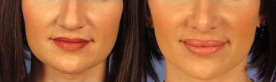 25-34 year old woman treated with Lip Augmentation - She had 1cc of Juvederm injected into her lips. Here she is at 2 months. Of note, she also had a rhinoplasty.