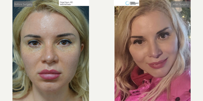 35-44 year old woman treated with Facelift - Mid Face Lift