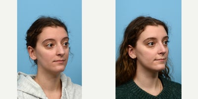 18-24 year old woman treated with Septoplasty - Looking to correct some breathing problems along with improving her nose shape, this 23-year-old patient turned to Dr. Wise for rhino-and septoplasty. Six weeks after the surgery, the patient loves her new nose and ability to breathe easy.