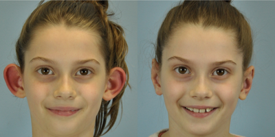 8 year old child treated with Otoplasty - This 8 year old child underwent ear pinning surgery called otoplasty.