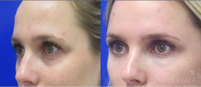 Woman treated with Radiesse - Woman treated with Radiesse