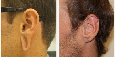 18-24 year old woman treated with Ear Lobe Surgery - This gentleman had ear lobe repair after having his ear gauges removed. Dr. Richards was able to provide him with a natural looking result.