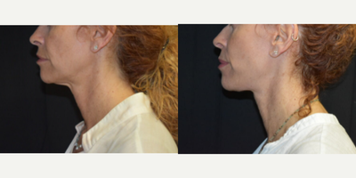 Woman treated with Facelift - Woman treated with Facelift