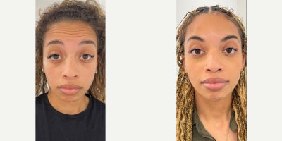 25-34 year old woman treated with Dysport - Upper face Dysport treatment.
