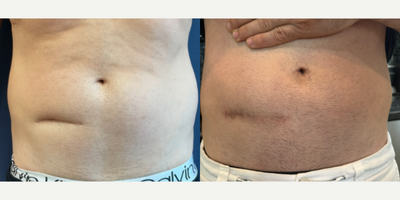 45-54 year old man treated with Scar Removal - This patient underwent an in-office scar revision procedure to correct an inverted scar deformity, which resulted in a significantly improved contour and shape of his abdomen. The scars will continue to fade over time.