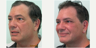 55-64 year old man treated with Upper and Lower Eyelid Surgery - This active middle-aged gentleman presented to our Center with the concerns of tired looking eyes. He did not like the bags under his eyes, nor the excess skin above. He had tried botox a number of times without significant improvement of his concerns. He wished for longer lasting and near-permanent results. We decided together to perform a lower blepharoplasty to remove the fat bags under his eyes. We also agreed to perform an upper blepharoplasty to remove the excess skin (hooding) above them. Both procedures were performed on the same day in our office under local anesthesia and mild oral sedation with xanax. Procedure time was under two hours total. Sutures were removed in 5 days and he was able to return to the gym 2 days after sutures were removed.His results show significant improvement and rejuvenation in the upper and lower lids while maintaining a natural well-rested appearance.