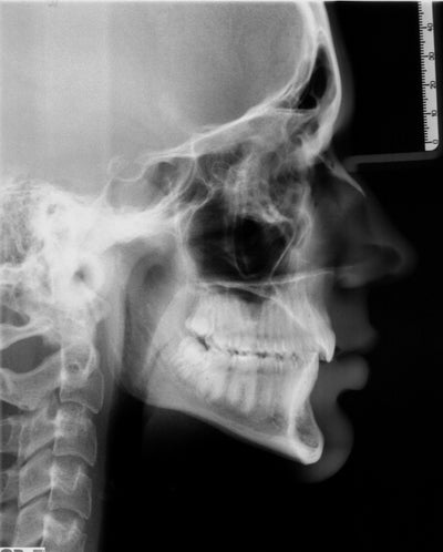 Treatment For Malloclusion Class 2 Deep Bite, Retracted Jaw? (photo 