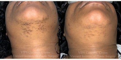 45-54 year old woman treated with Laser Hair Removal - This patient completed three laser hair removal treatments to address dense, hormonally driven hair growth along the chin and lower face.Her before photos show coarse, dark terminal hairs with visible irritation and inflammation in the follicular area a common pattern in patients experiencing hormonal flare-ups or conditions such as PCOS.After three sessions, there is a clear reduction in hair density. The coarse hairs are greatly minimized, the shadowing and pigmentation are lighter, and the skin appears smoother and less inflamed. You can also see fewer bumps and ingrown hairs, reflecting healthier, calmer follicles. Laser hair removal is especially effective for patients with hormonally influenced hair growth, providing long-term reduction and noticeably clearer, more even skin.
