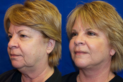 Woman over 60 years old treated with Facelift - Woman over 60 years old treated with Facelift