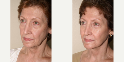 65-74 year old woman treated with Facelift - Short scar facelift, neck lift with neck liposuction, Restylane injections, and upper and lower eyelid blepharoplasty.This 74 year old woman underwent these outpatient procedures under local anesthesia with sedation.