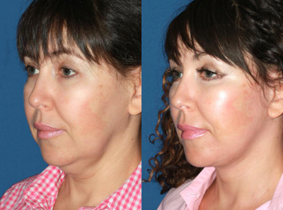 45-54 year old woman treated with Facelift - This patient presents with concerns of sagging neck skin and jowls. Good skin quality full cheeks make her an excelent candidate for facial rejuvenation. Face and neck lift was performed to restore the contour of the neck and jawline resulting in a significantly rejuvenated appearance.