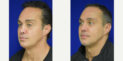 35-44 year old New Orleans man treated with Voluma and Vollure to the cheek and under eye region - Combination of Volluma and Vollure to treat the periorbital region with result of improved balance and decreased hollowness throughout the cheek and under eye areas. He also underwent revision rhinoplasty 6 weeks prior to filler injections.