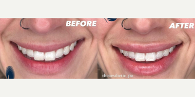 Woman treated with Restylane, Botox - For these lips I used 1 syringe of restylane as well as a Botox lip flip