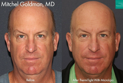 Man treated with ThermiTight - ThermiTight and MicroLipo to sculpt the chin, jawline, and neck of a male patient by Dr. Goldman