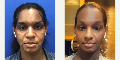 Patient treated with African American Rhinoplasty - Septorhinoplasty (Closed) with Cartilage Grafts - 25 to 34 year-old female patient is 7 months post-op from Facial Feminization surgery. Her procedures included: Forehead Lift, Hairline Lowering, Orbital Bony Contouring; Septorhinoplasty (Closed) with Cartilage Grafts and Weirs; Chin Reduction and Contour; Soft Tissue to Nasolabial Folds; Subnasal Lip Lift; Thyroid Cartilage Shave and 2 ccs Juvederm Voluma.
