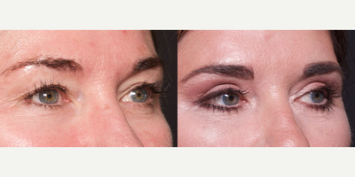 Woman treated with Brow Lift - Woman treated with Brow Lift