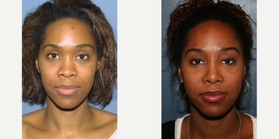 Woman treated with Rhinoplasty - Woman treated with Rhinoplasty