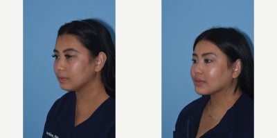 25-34 year old woman treated with Buccal Fat Removal, Chin Implant - My nurse loves the more sculpted appearance of her face. #chinimplant #neckliposuction #buccalfatremoval A rounder face is transformed in a beautifully subtle manner. The jawline looks chiseled with a slightly extended chin. Her cheek appears elevated and highlighted from the removal of #buccalfat. All in a natural way.