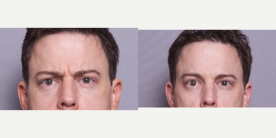 35-44 year old man treated with Botox - 35-44 year old man treated with Botox - forhead