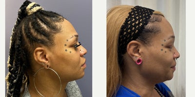 35-44 year old woman treated with Forehead Reduction, Brow Bone Reduction, Brow Lift, Facial Feminization Surgery - This young lady underwent forehead feminization, and chin feminization.