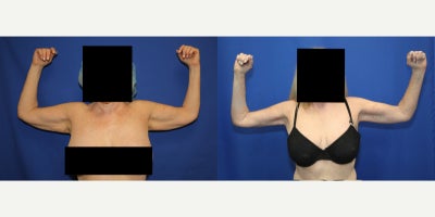 Brachioplasty Restores Smooth, Toned Arms and a More Youthful Contour - Loose skin on the arms is a common concern after major weight loss, and brachioplasty can offer a lasting solution when skin does not bounce back. Our patient is a 68-year-old White female who had previously been morbidly obese, with a maximum weight of 170 pounds. After losing weight through diet, exercise, and GLP-1 use, she reached 120 pounds, yet she was still bothered by the excess skin on her arms. She turned to Dr. J. Timothy Katzen for brachioplasty, also called an arm lift, to remove hanging skin and restore a firmer, more sculpted appearance of the upper arm. Performed under general anesthesia, this plastic surgery procedure involves carefully placed incisions in the inner arm, excision of redundant skin, removal of excess tissue when needed, and precise redraping of the remaining skin to create a smoother contour. Brachioplasty is especially helpful for post-weight-loss patients whose skin has been stretched and has lost the ability to contract on its own. The goal is not only to remove extra skin, but also to create better arm definition and a more proportional silhouette. An arm lift can make patients feel more confident in short sleeves, sleeveless tops, and everyday clothing. Her post-operative photos were taken 5 years after surgery and still show remarkable long-term arm lift results with tighter upper arms, improved contour, and a more youthful appearance. Her beautiful, durable outcome demonstrates how brachioplasty can provide lasting improvement after weight loss.