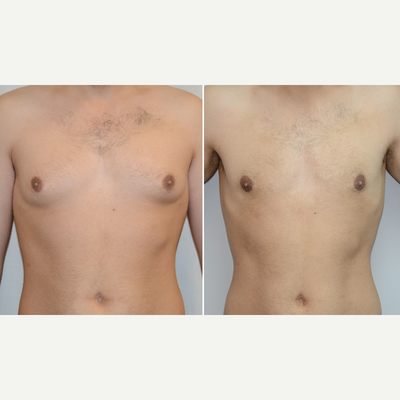 25-34 y.o man treated with breast reduction for gynecomastia, invisible scars - This gentleman suffered with enlarged breasts since his teenage years. The problem remained stubborn despite maintaining a lean body weight. He was treated with a male breast reduction using radio-frequency assisted liposuction (BodyTite). Excess breast gland and fat was removed through a small incision in the underarm such that there are no scars on the front of the chest.