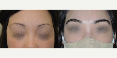 35-44 year old woman treated with Hair Transplant - Before and after eyebrow restoration for over-plucked eyebrows. 700 FUG grafts