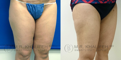 35-44 year old woman treated with Tumescent Liposuction - The inner thighs are a major cause of concern for many of our patients. a typical treatment will place incisions in the front of the groin and in the butt fold from behind, to make sure we get front and back.