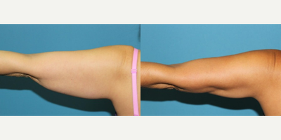 Woman treated with Vaser Liposuction - Liposuction - Arms / Axillary