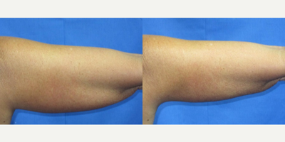 40 year old woman treated with Vaser Liposuction - This is a woman in her 40s maintains her health and is physically active. She has a good diet but has noticed gradual thickening and hanging in the upper arms as she ages. She loves to be outdoors during the summer but has been hesitant to wear sleeveless shirts and dresses due to the sagging and skin laxity of her upper arms. The procedure was done just before summer. She was clear in her wishes that she would recover quickly so she could enjoy herself and not be restricted in physical activity over the summer months. On examination, we found fatty accumulation and skin laxity in the posterior upper arm. The right arm was worse (larger) than the left as is often the case. Most people are not symmetrical if you look closely. The procedure was explained to the patient and the surgical alternative of a brachioplasty was also discussed. This is an arms reduction operation removing skin and fat from the back of the upper arm from the elbow to the armpit. She was not interested in having the surgical scar along the back of her arm associated with brachioplasty. We removed 600 cc total, or the equivalent of one 12 oz. soda can of fat from each arm. She took one pain pill overnight and rated her pain as a 2 or 3 on a scale of 1 to 10. She had good drainage from the incision sites into her bandages which is expected and a wanted outcome. These before and after photos show the results at 4 weeks after the procedure. There is some immediate skin tightening as well as fat reduction. There is still a little thickening of the tissues still which will soften and smooth over the next several weeks. We expect to see more gradual skin tightening for the next 5 or 6 months. Although not perfect, the arms are much more symmetrical. She came back to work in 2 days and had full activity in 2 weeks.