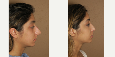 25-34 year old woman treated with Rhinoplasty - rhinoplasty