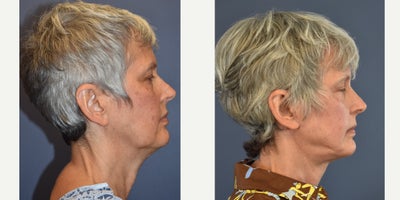 Woman treated with Facelift, Neck Lift - Woman treated with Facelift, Neck Lift