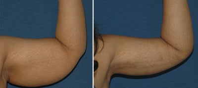 Brachioplasty -
Brachioplasty with BodyTite contouring to upper arm