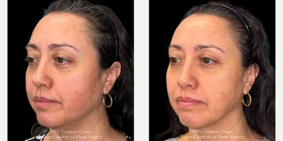 45-54 year old woman treated with CoolPeel, CO2 Laser - This 45-54 year old female patient underwent two CoolPeel CO Laser Skin Resurfacing treatments to improve overall skin texture and tone. Her results show smoother, more even skin with reduced fine lines and redness, revealing a refreshed and healthier-looking complexion with little to no downtime.