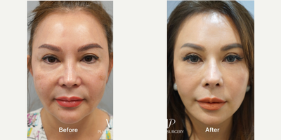 55-64 year old woman treated with Asian Rhinoplasty, Rhinoplasty, Revision Rhinoplasty, Facelift, Deep Plane Facelift, SMAS Face - 2 year post operative surgery before and after for 60-year-old female patientSurgery List:Extended deep plane faceliftNecklift, Middle neck plicationRib cartilage rhinoplasty, Mid face augmentationEndoscopic forehead & brow liftFull face fat graftingStem cell treatmentPerformed by VIP Plastic Surgery chief surgeon, Dr. Myung Ju Lee