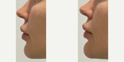 25-34 year old woman treated with Dermal Fillers - Chin after injecting 1 syringe of Voluma