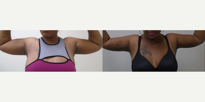 Woman treated with Smart Lipo, Laser Liposuction - Woman treated with Smart Lipo, Laser Liposuction