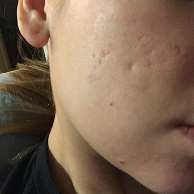 Acne Scar Treatment Need Advice Please Help - California Acne Scar Treatment Need Advice Please Help - California