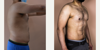 25-34 year old man treated with Abdominal Etching - This young male requested hi-definition liposuction of his abdomen to remove unwanted, exercise-resistant fat. He is shown her at 2 months post-op. The beauty of this operation is that the results will continue to improve because the definition is created to complement the underlying anatomy.