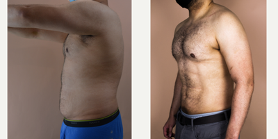 25-34 year old man treated with Abdominal Etching - This young male requested hi-definition liposuction of his abdomen to remove unwanted, exercise-resistant fat. He is shown her at 2 months post-op. The beauty of this operation is that the results will continue to improve because the definition is created to complement the underlying anatomy.