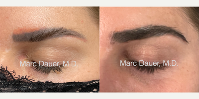 Woman treated with Eyebrow Transplant - Woman treated with Eyebrow Transplant