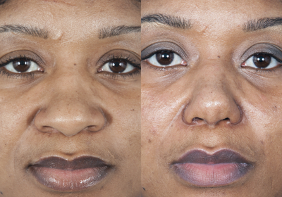 35 yo African American female treated for wide flat tip and droopy tip  - 35 yo African American female treated for wide flat tip and droopy tip by Dr. Jose Barrera