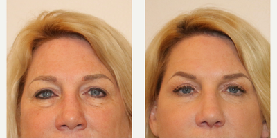 45-54 year old woman treated with Eyelid Surgery - This is a pleasant 50s patient showing before and after lower face and neck lift and lower eyelid blepharoplasty.