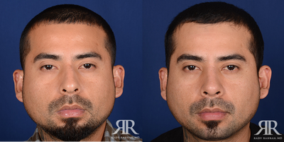 Rhinoplasty - Rhinoplasty