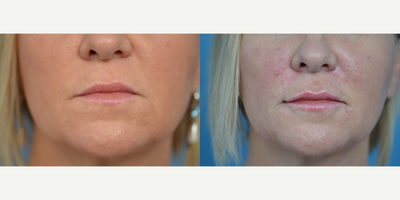 45-54 year old woman treated with Lip Augmentation - 51 year old patient concerned with the unevenness in lip appearance. She was treated with Vollure to achieve a very natural, rejuvenated appearance. She was also treated with Juvederm to reduce the lines around her mouth.