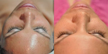 Glycolic Peel