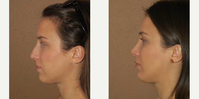 18-24 year old woman treated with Rhinoplasty - rhinoplasty