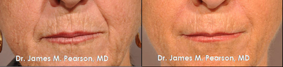 Injectable Filler Treatment -
Injectable Filler Treatment