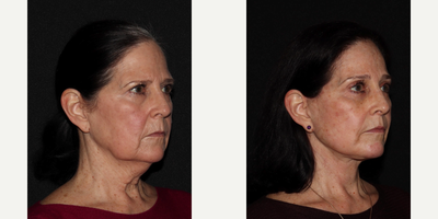 65-74 year old woman treated with Facelift, Brow Lift, Eyelid Surgery, Lip Lift, Facial Fat Transfer - MD Restore, Deep-Plane (Additional Procedures: Brow Lift, Eyelids, Lip Lift, Fat Transfer)